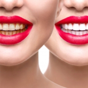 Advantage and Disadvantage of tooth bleaching