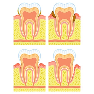 What is the cause of Gingival Recession? How to prevent it?