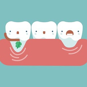 How to prevent the gingival recession? 