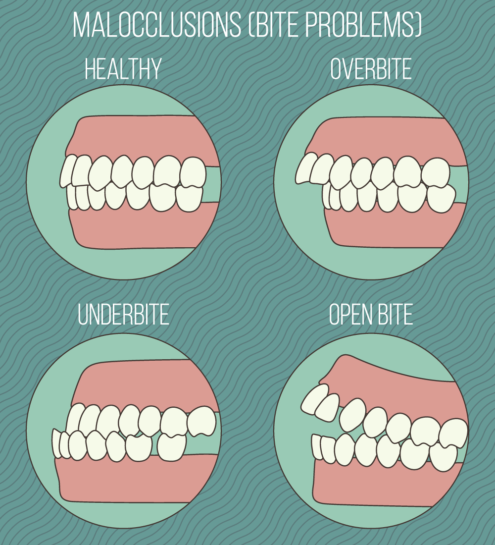 Does The Malocclusion bite Problems Effect Your Daily Life 